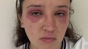 Élete legszebb napja rémálommá vált: súlyos allergiás reakció torzította el a menyasszony arcát